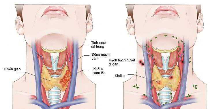 CESTI - Nghiên cứu một số tính chất phân tử của ung thư vòm họng ...